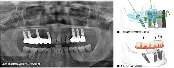 美奥口腔All-on-4种植牙案例