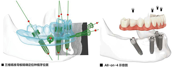 三维种植导板和All on 4种植牙