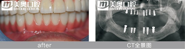苏州美奥口腔种植牙案例