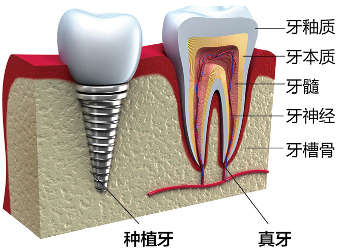 种植牙与真牙对比图
